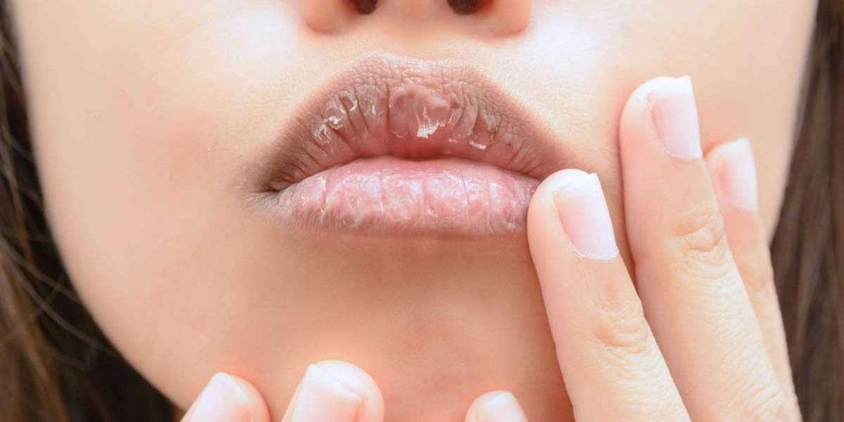 Can Vitamin Deficiencies Cause Chapped Lips?