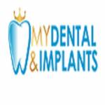 My Dental Implants